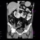 Horseshoe kidney: CT - Computed tomography